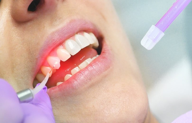 Laserterapia na Clínica Odontológica é tema central da V Semana de Odontologia da UNIFASE